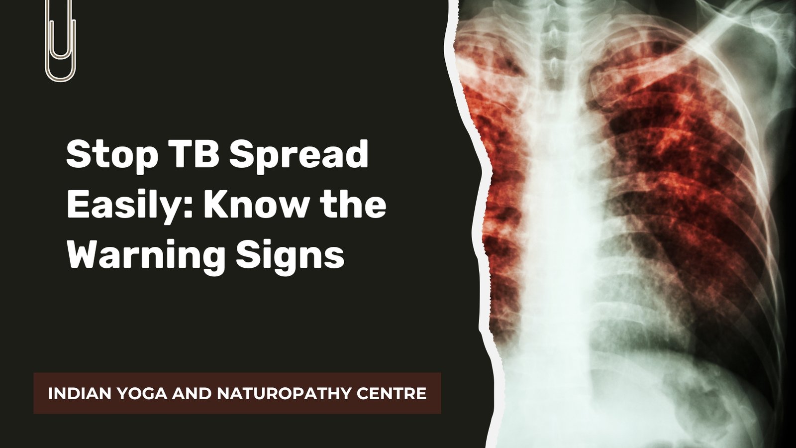 Stop TB Spread Easily: Know the Warning Signs